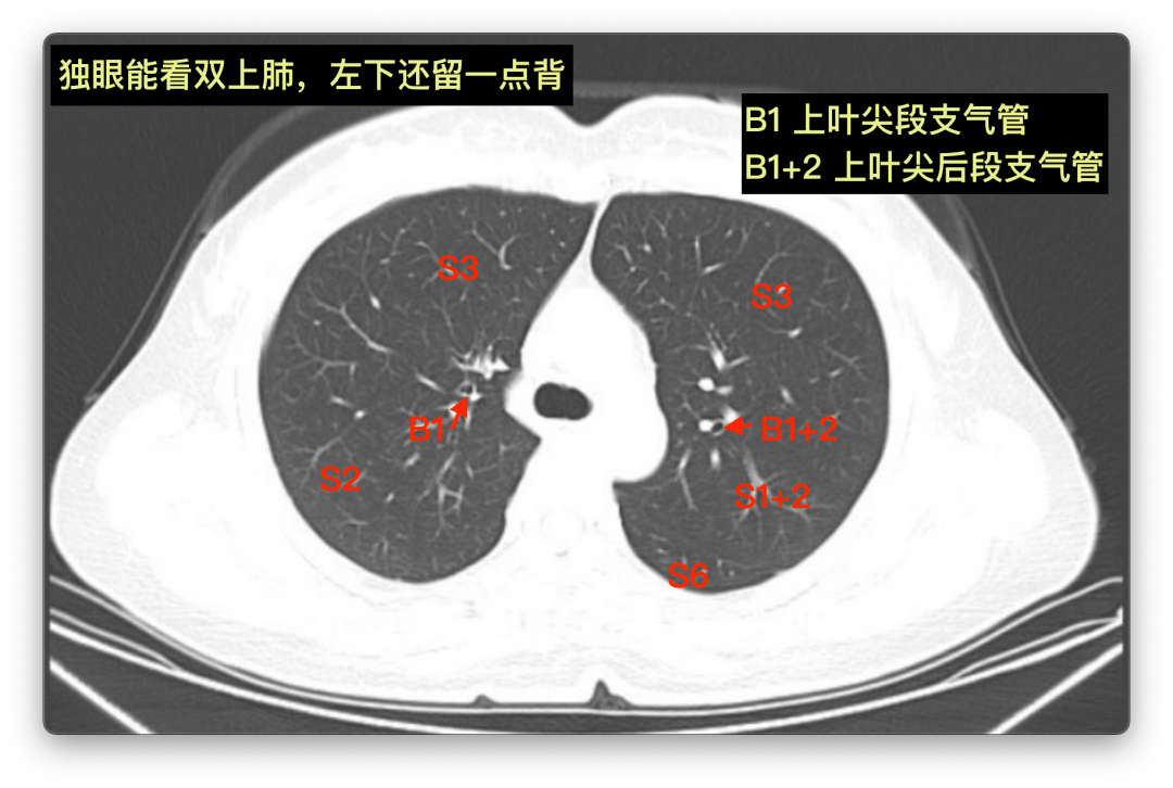 右肺上叶尖后段位置图图片