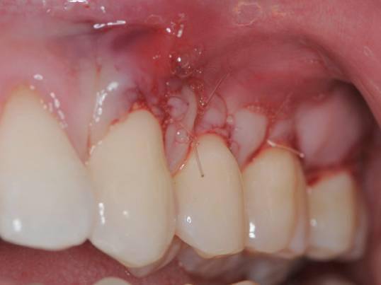种植牙骨丧失,牙龈萎缩,附着龈丧失,植体螺纹暴露图26 翻瓣后发现骨