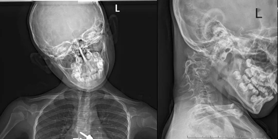 恢复正常经过科室讨论,当下小宋的主要问题是僵硬性下颈椎侧后凸畸形