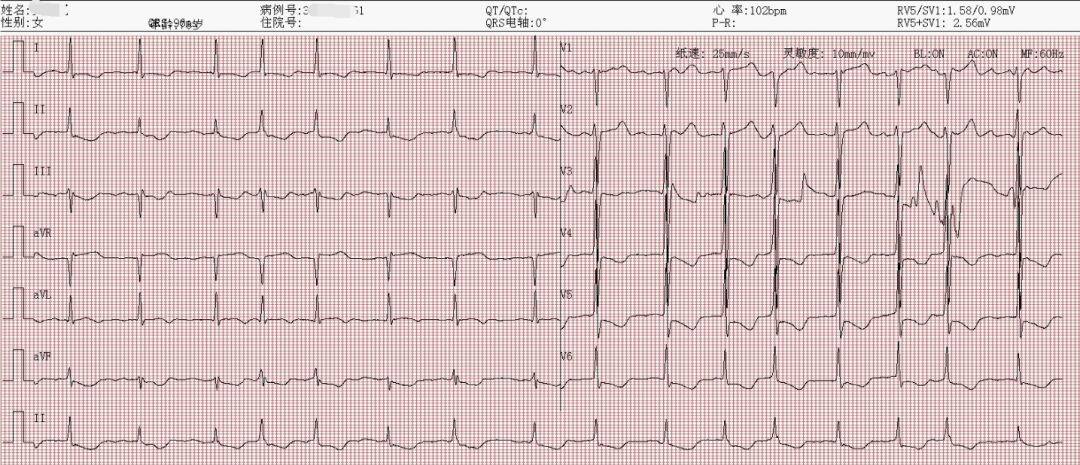 入院心電圖房顫心律,qrs 波電壓升高,v4~6 導聯 st 段壓低,t 波倒置圖