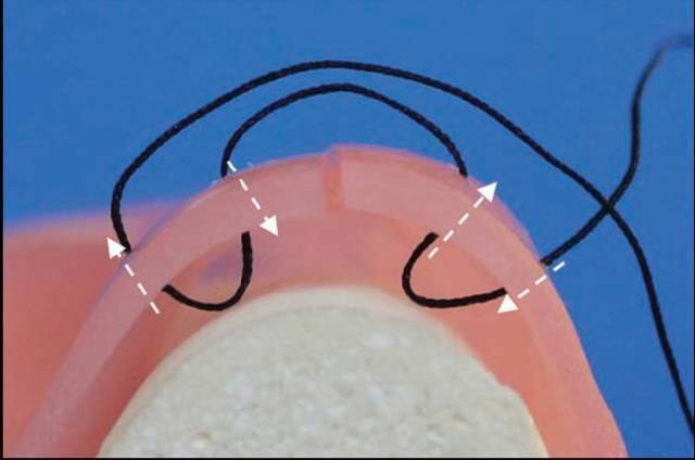 牙醫學堂圖解種植牙口腔黏膜的縫合