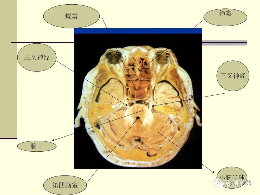 三叉神经解剖及常见疾病mr表现