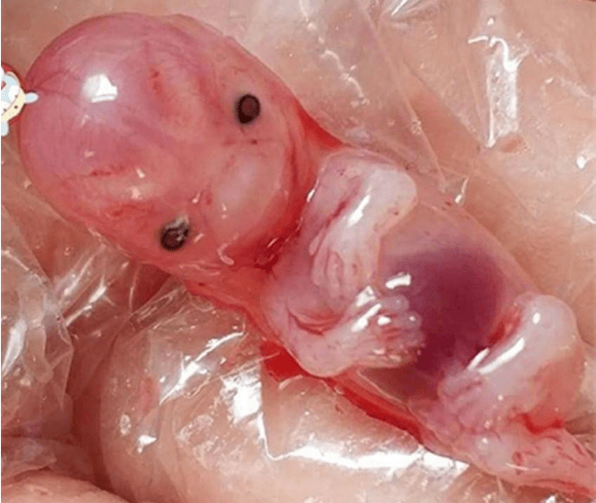50天流产排出胚胎图片图片