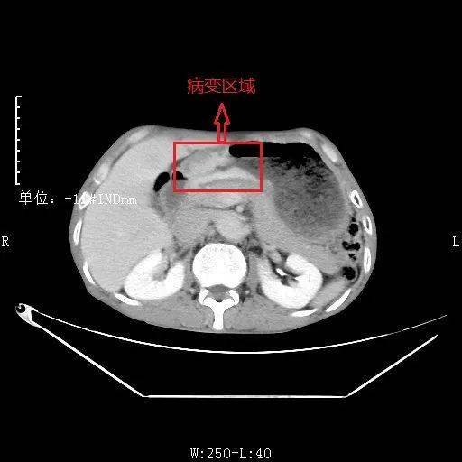 加重1月"入院,结合上腹部ct,胃镜,病理检查结果,诊断为:1,胃窦恶性