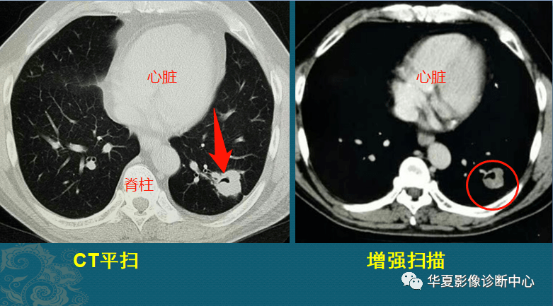 如何看懂肺癌CT图片图片