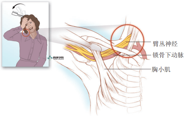 抬臂负荷试验是指让患者抬臂过头,反复握拳松拳.