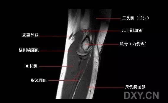 肘關節mri圖譜超全整理及常見病變mr診斷