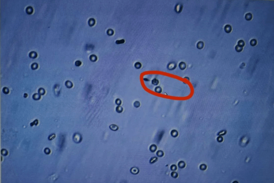 睾丸显微取精手术助无精子症患者圆求子梦