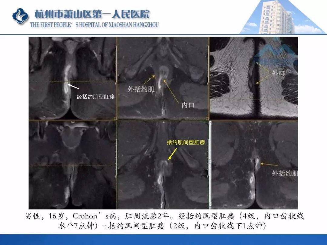 肛提肌mri图片