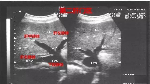 肝脏第一肝门超声图像图片