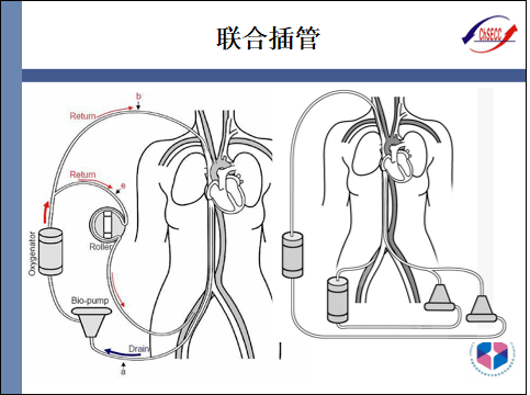 pptecmo插管技术与部位选择
