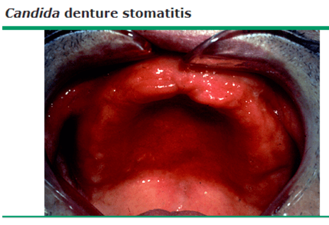 口腔黏膜长了斑小心癌变99的风湿科医生都分辨不了