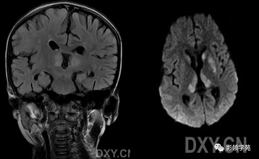 wernicke脑病mri表现