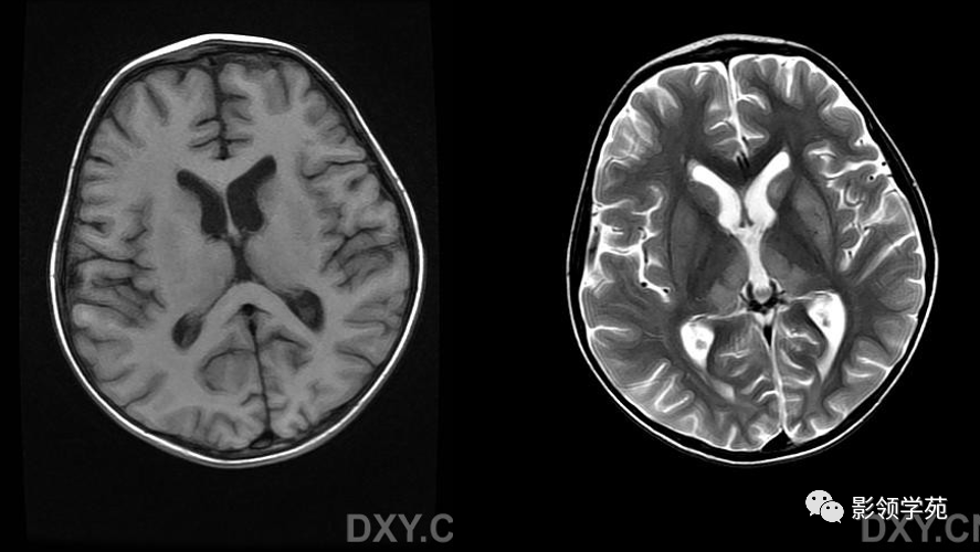 wernicke脑病mri表现
