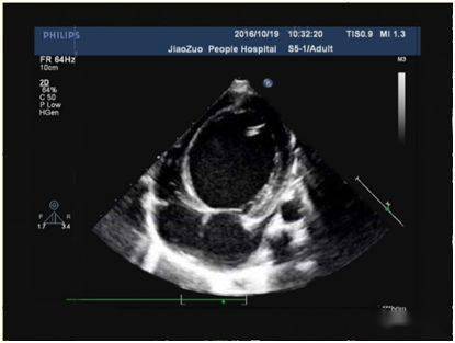 心内膜胶原弹力纤维增生症 (endocardial fibroelastosis,efe) 是指心