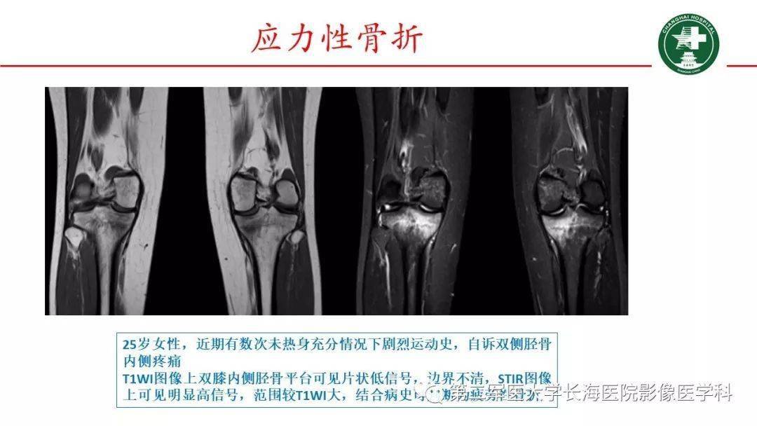 膝关节骨髓水肿的mri影像表现