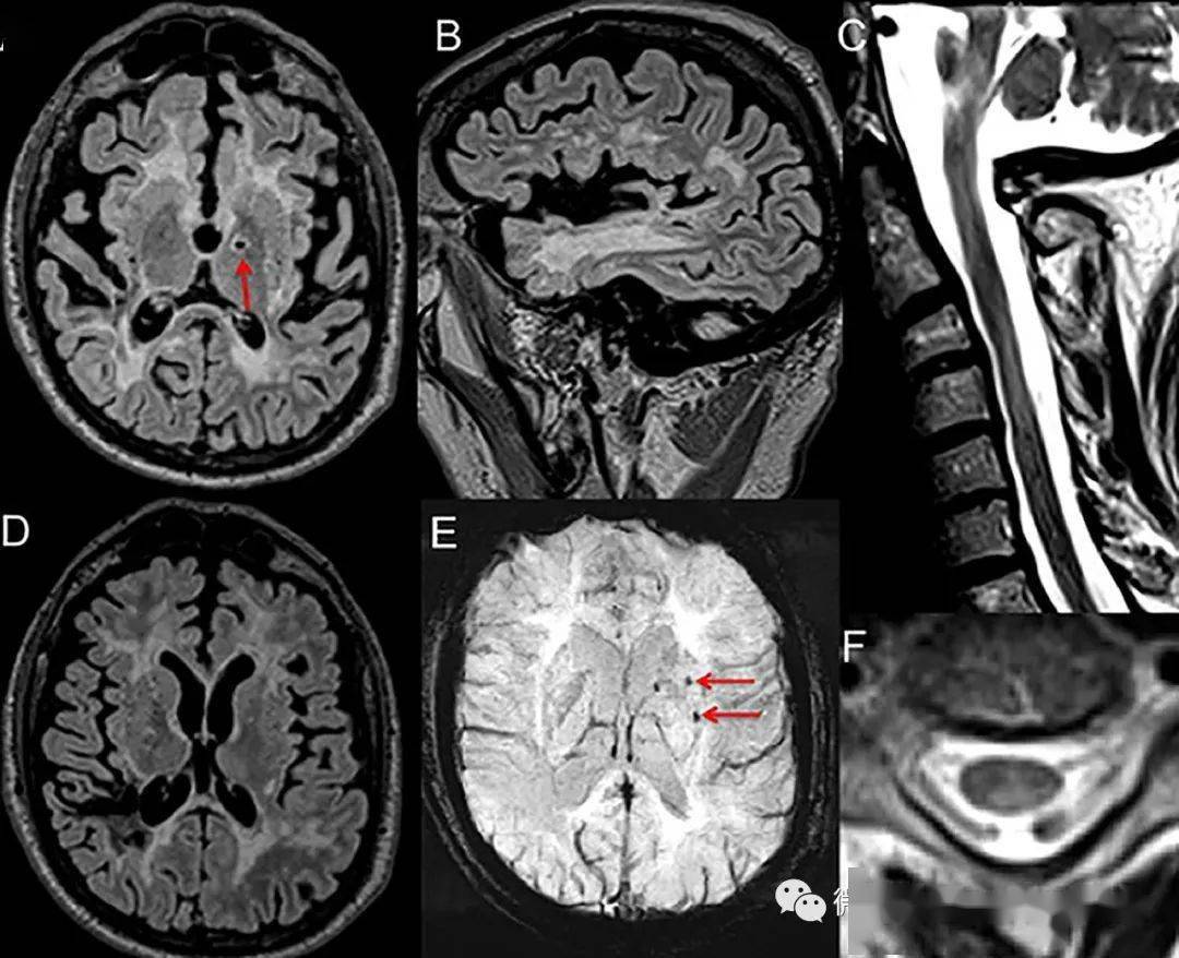 图:a-b:flair可见脑白质病变,累及外囊和前颞叶,箭所示为深部灰质腔隙