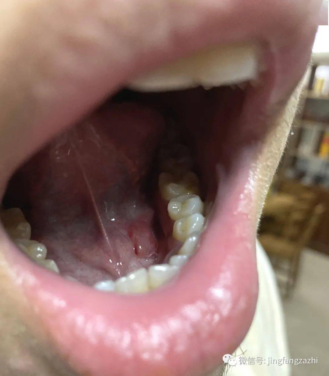 舌下腺囊肿术后照片图片