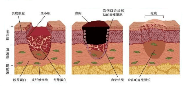 炎症的自述:发生、机理和结局_组织