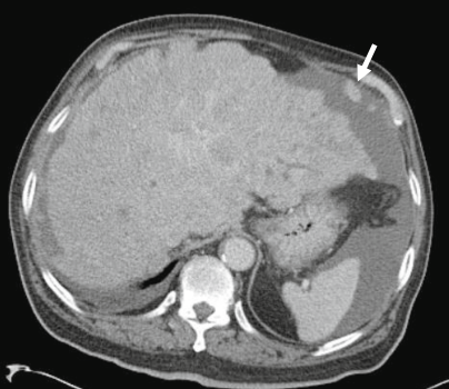 肝包膜皱缩除了胆管细胞癌还有这几种情况