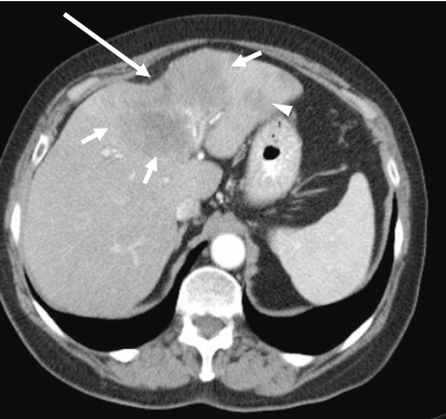 肝包膜皱缩除了胆管细胞癌还有这几种情况