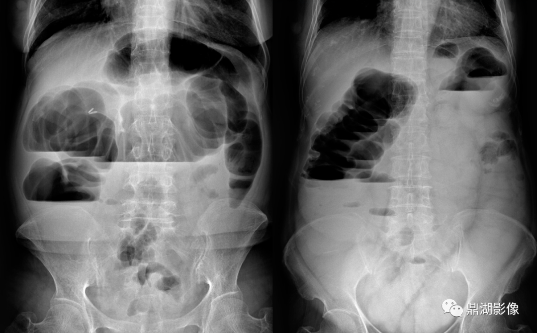 肠胀气x光图片图片