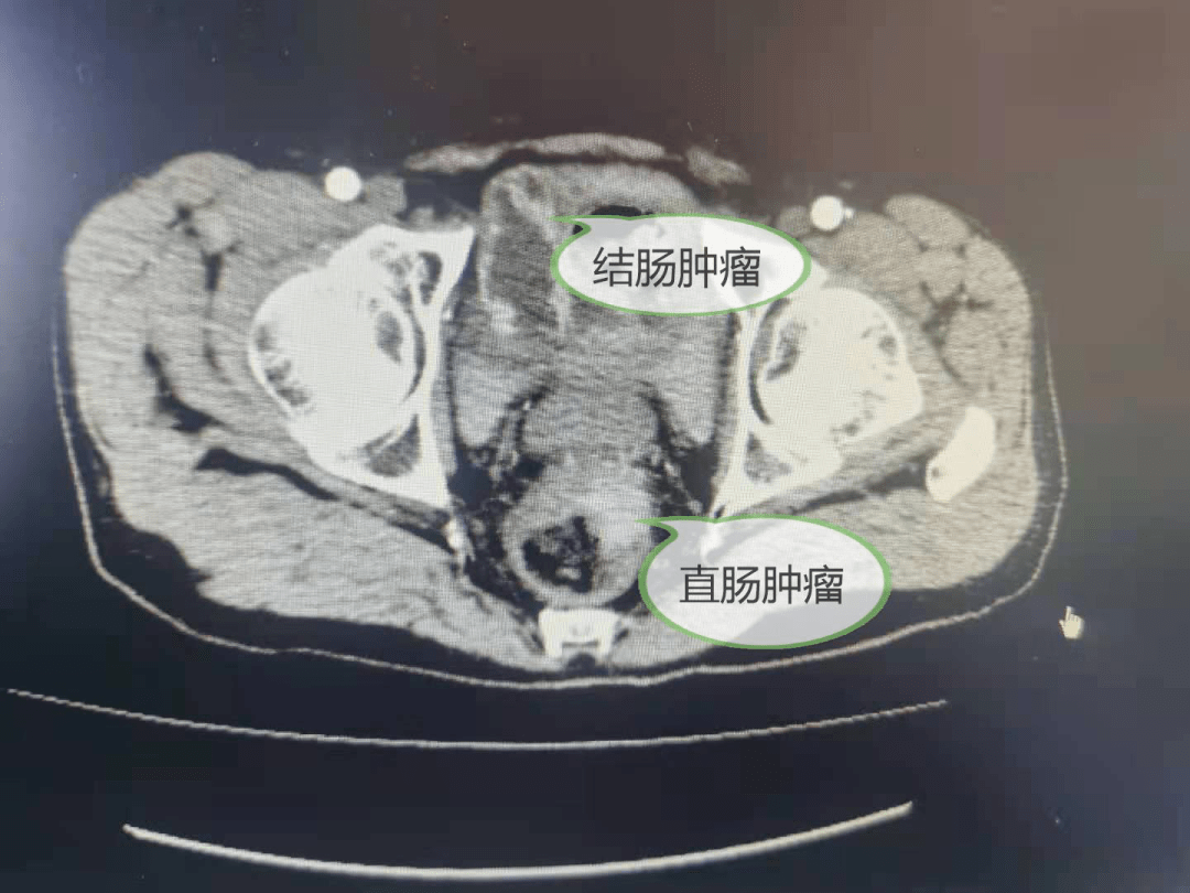 伴排便困难,肛门下坠",入院诊断为低位直肠癌,直肠肿瘤距肛门约4cm
