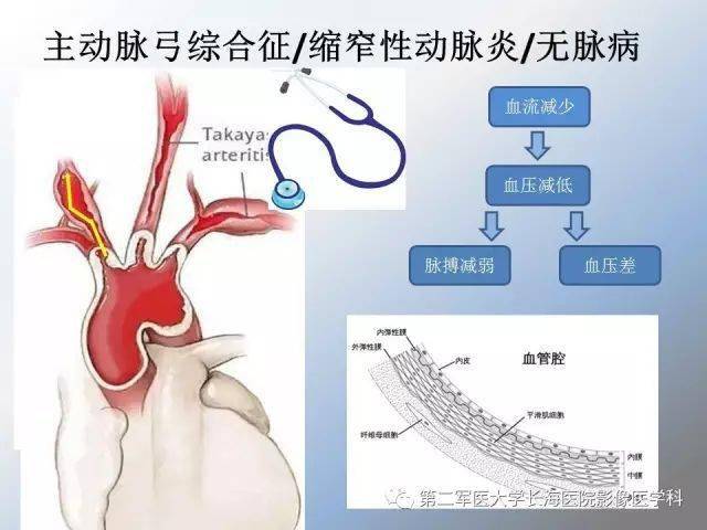 东方美人病:多发性大动脉炎