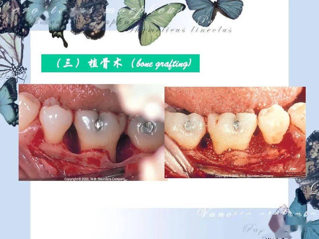 牙槽骨的吸收程度和类型