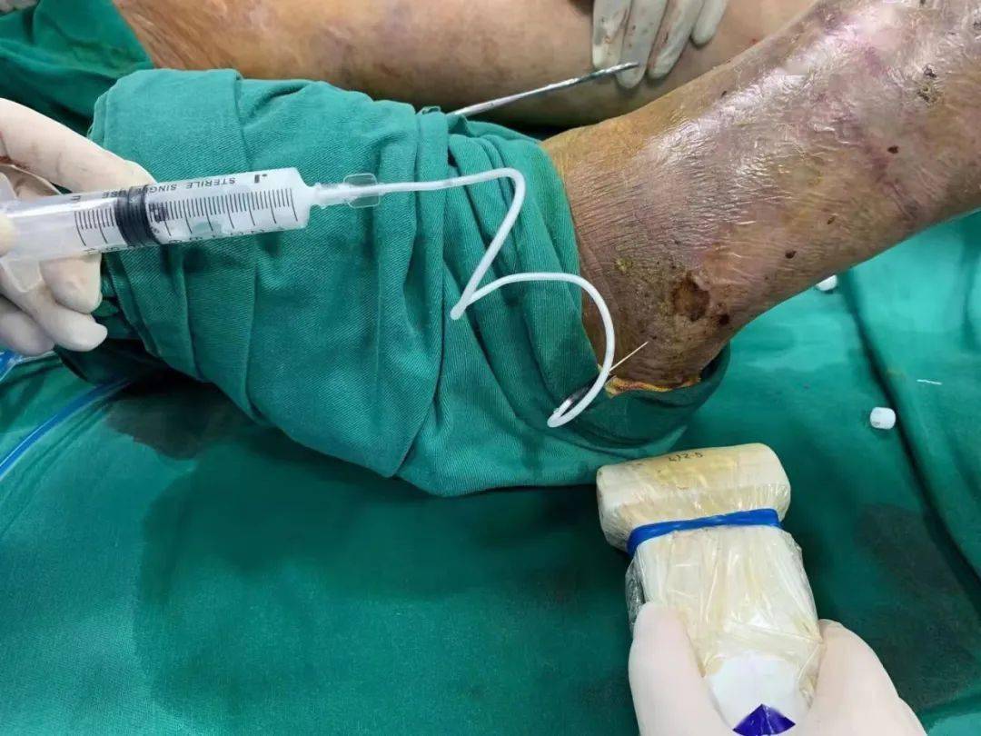 病例分享射频闭合联合聚桂醇泡沫硬化治疗下肢静脉曲张