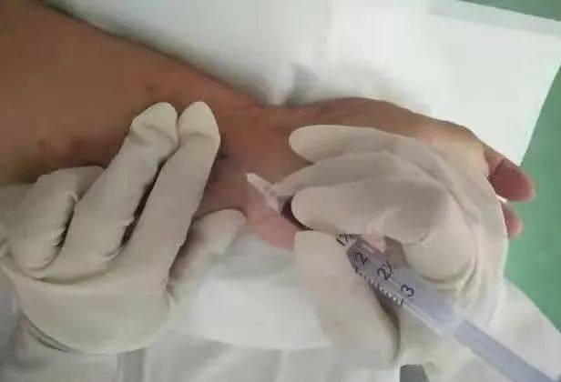 动脉采血如何做到一针见血