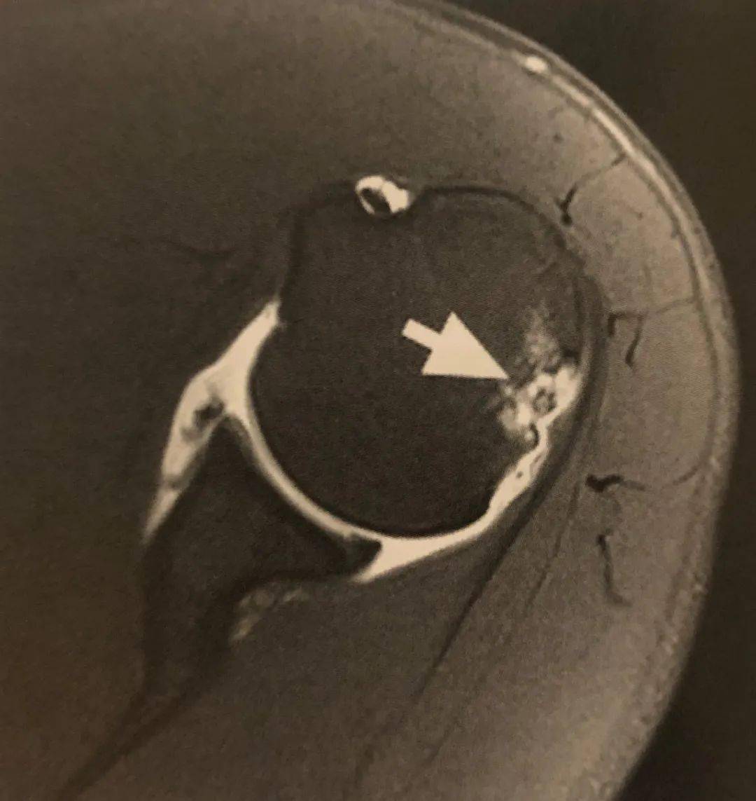 【值得收藏】15 個經典肩部疾病的影像學徵象!