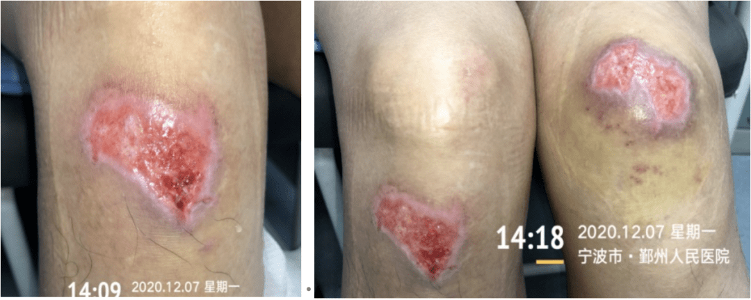 皮肤伤口包扎vs暴露如何选一个案例教你掌握