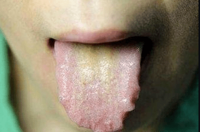 舌头有齿痕说明这里虚艾灸一招就搞定