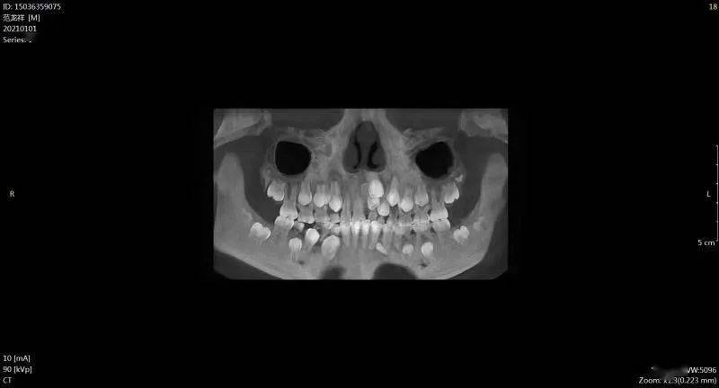 范xx 20210101 多生牙cbct  150xxxx9075