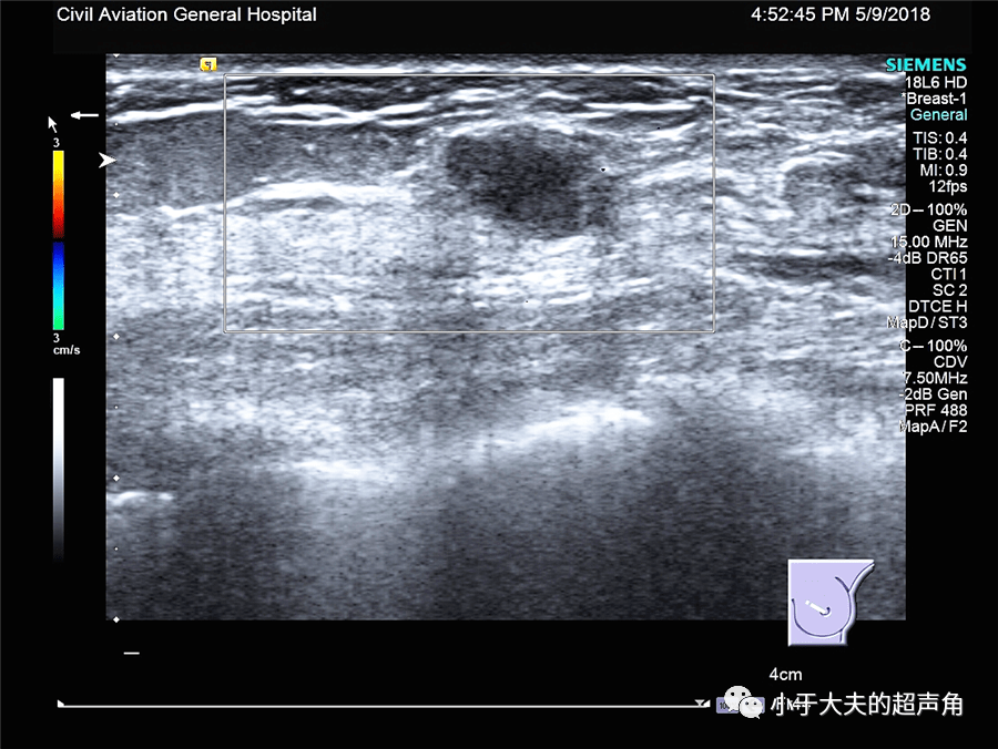 >>>新年好<<< 超声随响 第43期 乳腺叶状肿瘤 =