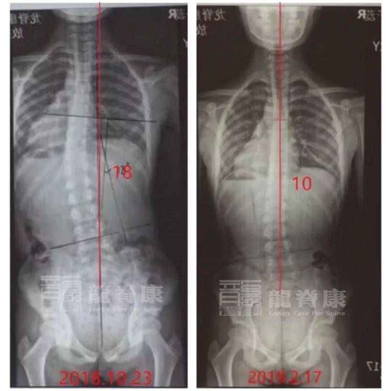 病例:脊柱侧弯不痛就不治疗?这位50岁阿姨腰椎退化堪比80岁老人_影响