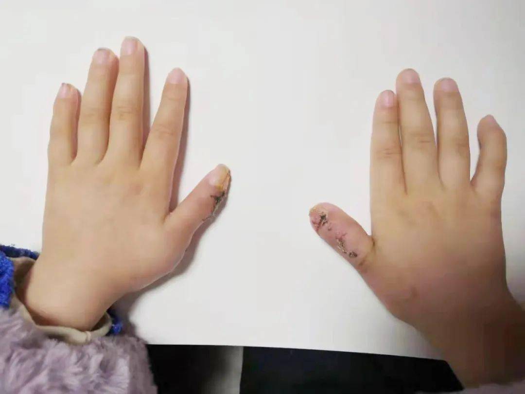 曾经的小"六指琴魔"不见了,双手基本上恢复了正常的外观,手术切口愈合