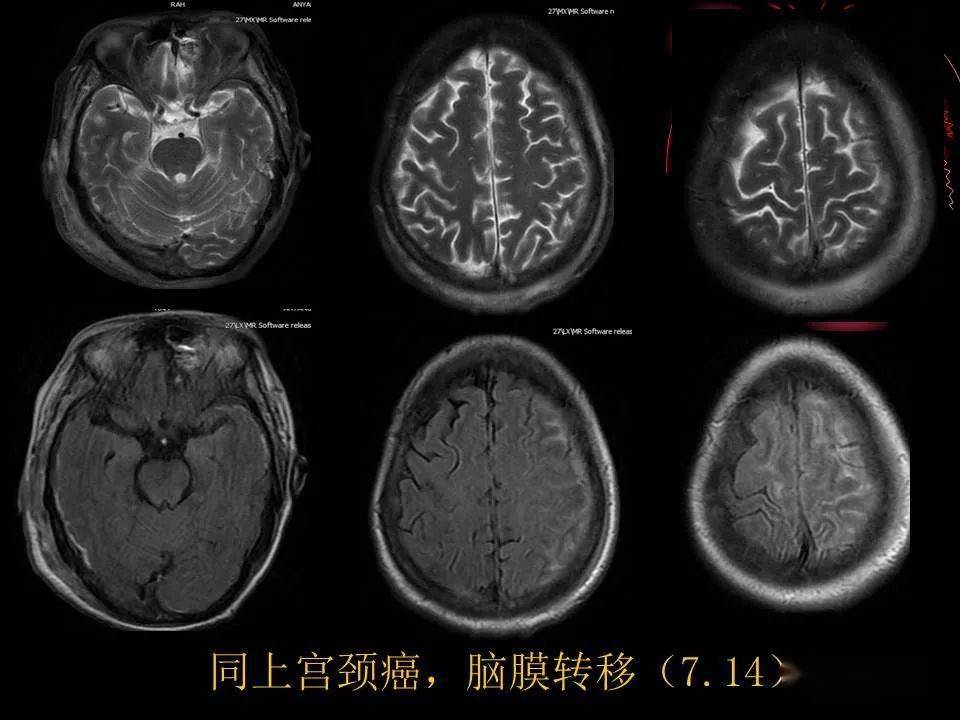 熟悉又陌生的脑膜癌病