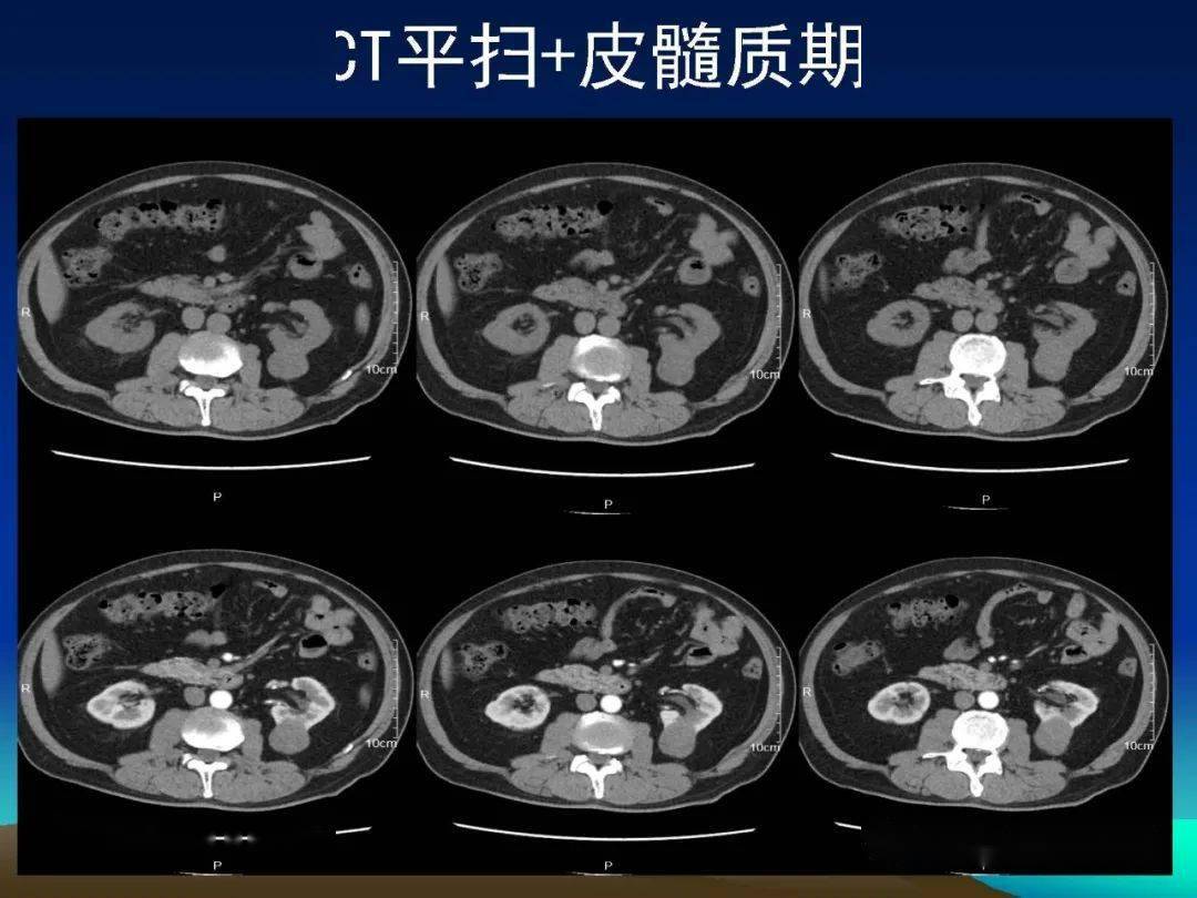 肾脏丨乳头状肾癌两例