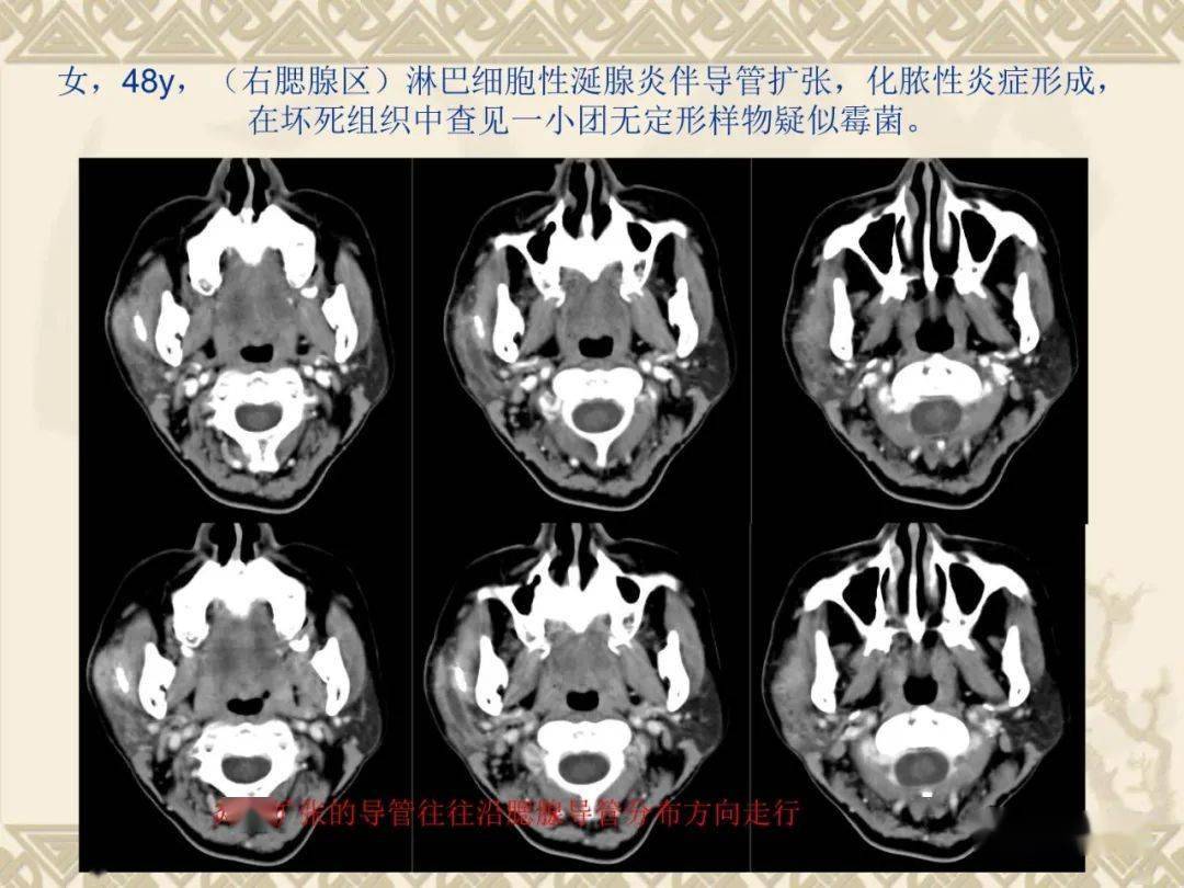 腮腺解剖结构图CT图片