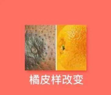 橘子皮乳房图片
