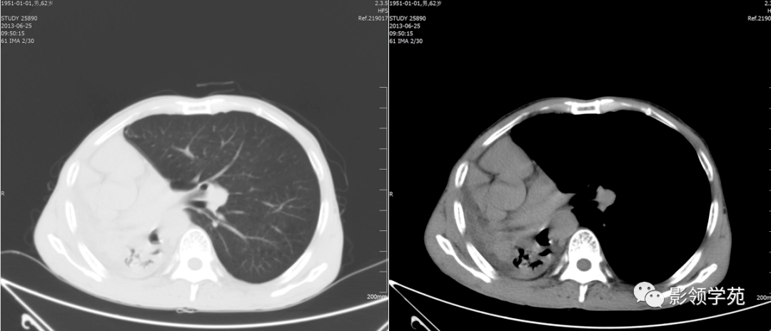 肺不张影像表现