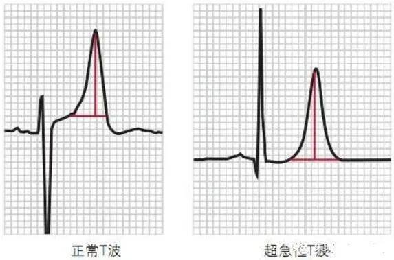 t波的演变过程为