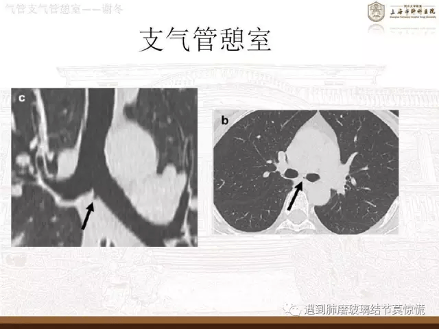 遇到氣管支氣管憩室莫驚慌