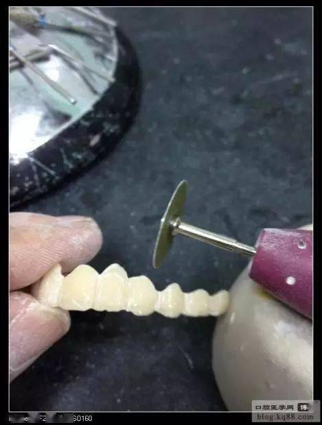 临时冠集锦_树脂