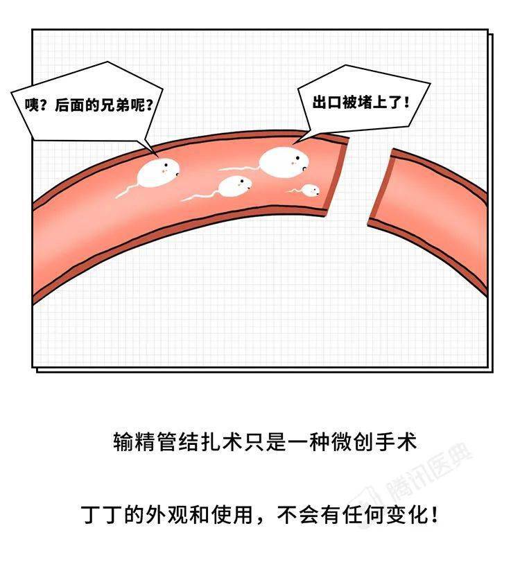 男人结扎位置图片真实图片