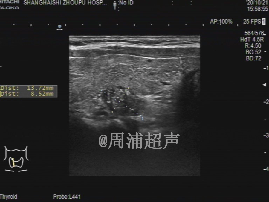 科普甲状腺结节的分级
