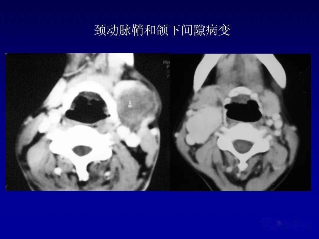 颌面部解剖及其病变的影像诊断