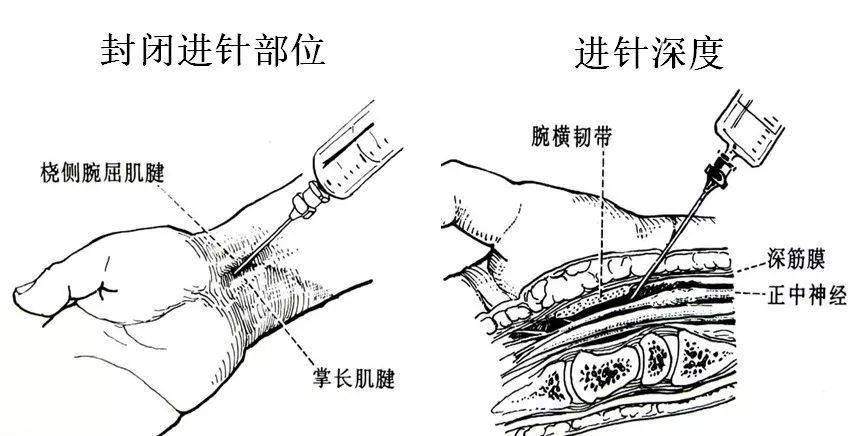 一针治愈腕管综合症图片